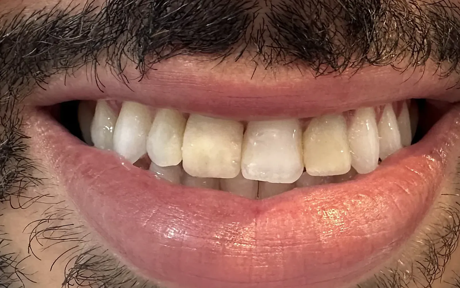 Sorriso antes do tratamento — Facetas em porcelana