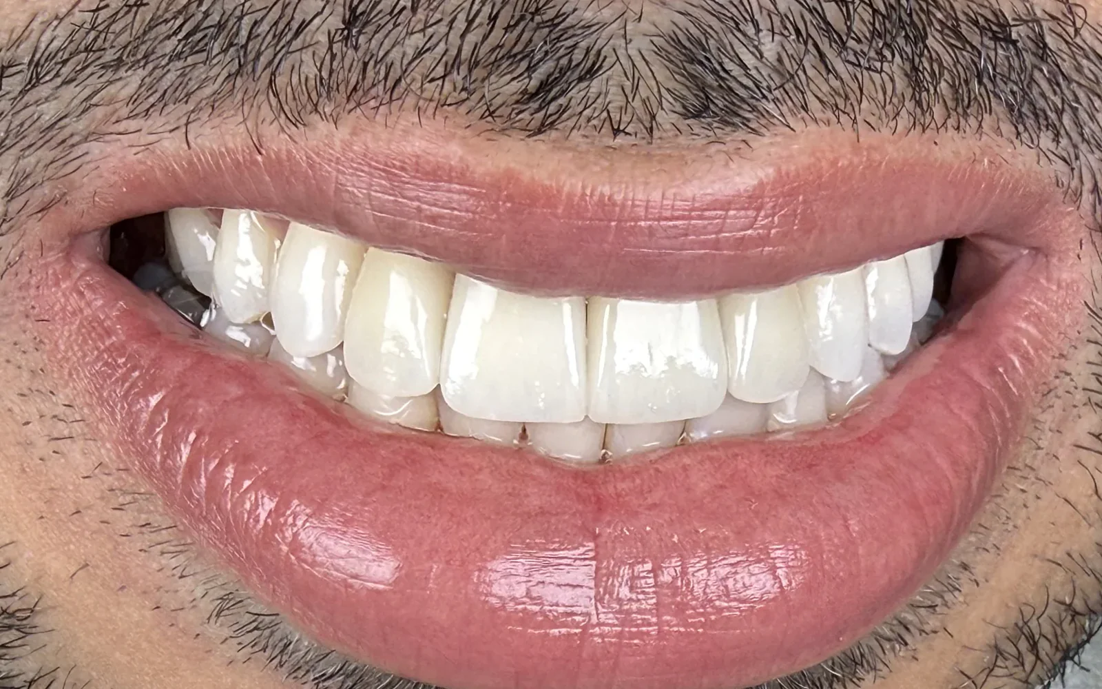 Sorriso depois do tratamento — Facetas em porcelana